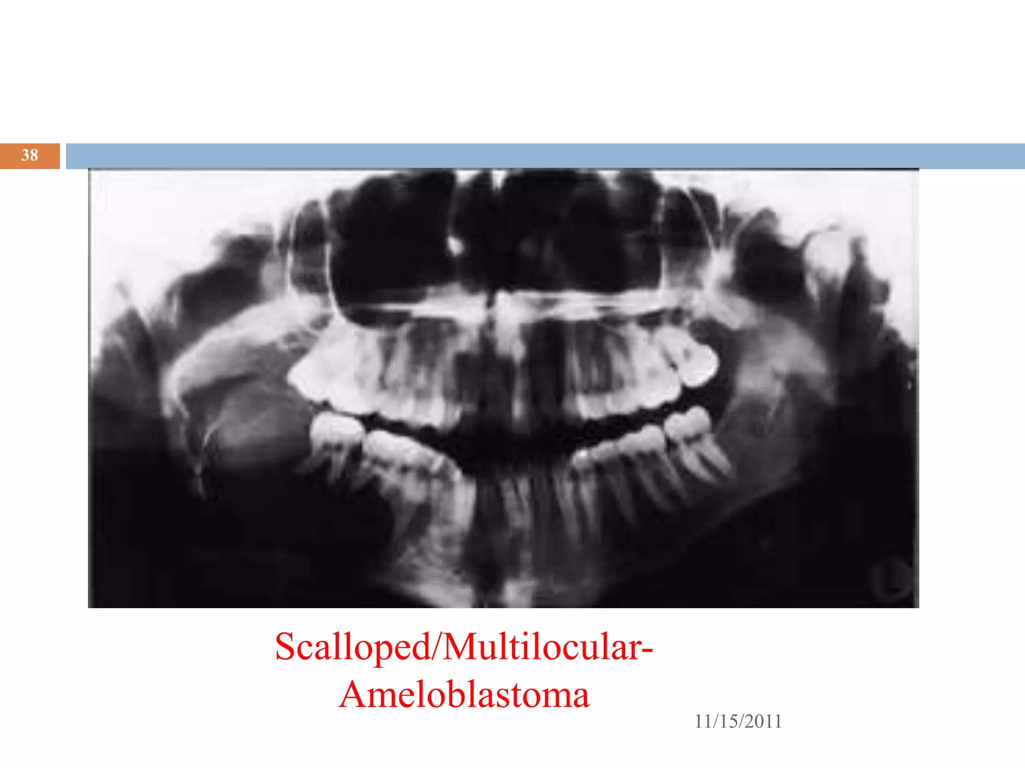 38




     Scalloped/Multilocular-
         Ameloblastoma
                               11/15/2011
 