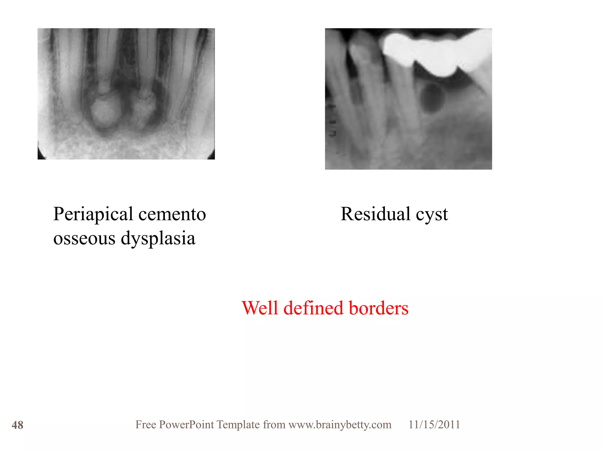 Periapical cemento                              Residual cyst
     osseous dysplasia


                                  Well defined borders




48            Free PowerPoint Template from www.brainybetty.com   11/15/2011
 