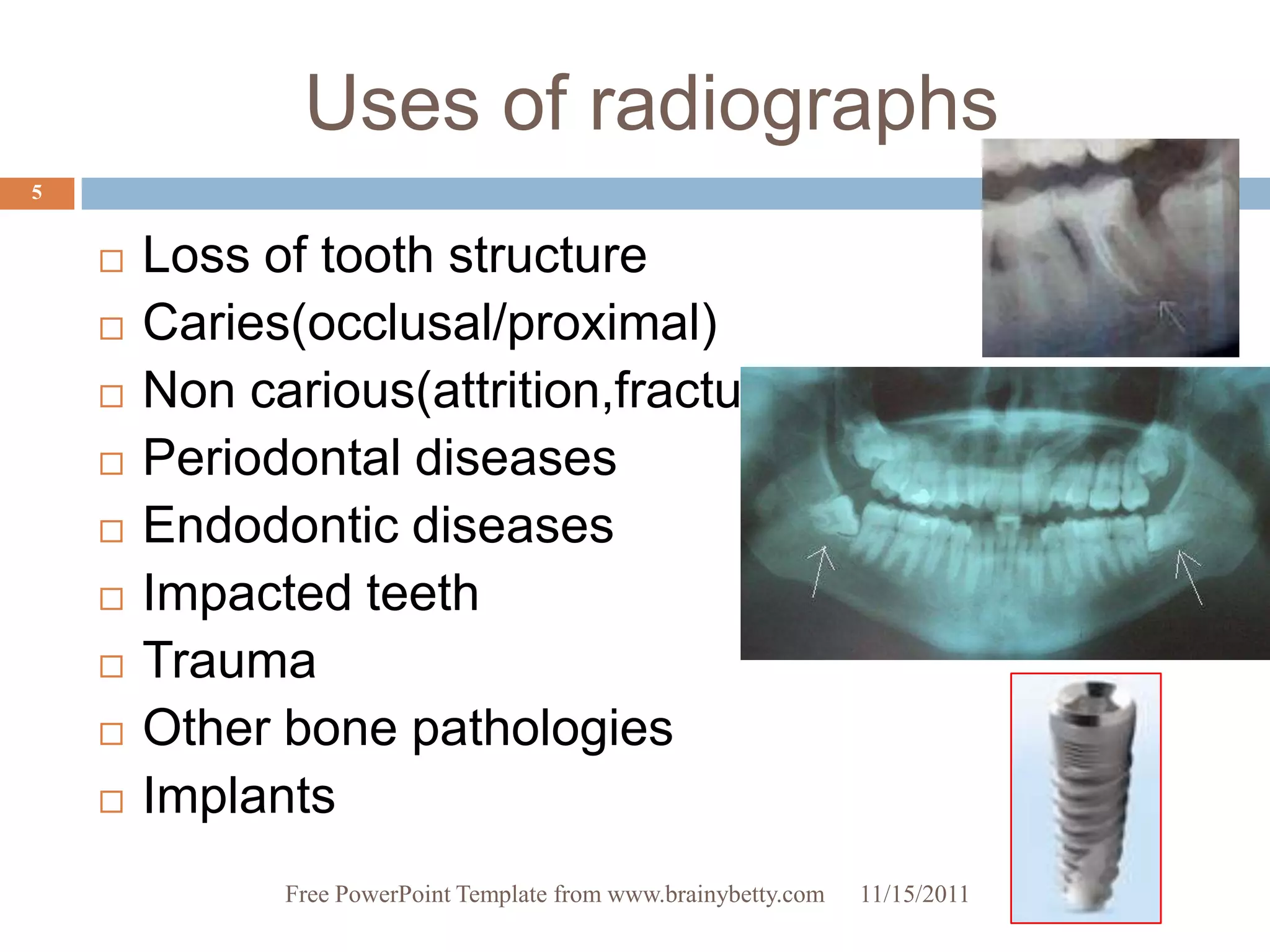 Uses of radiographs
5


       Loss of tooth structure
       Caries(occlusal/proximal)
       Non carious(attrition,fracture)
       Periodontal diseases
       Endodontic diseases
       Impacted teeth
       Trauma
       Other bone pathologies
       Implants
              Free PowerPoint Template from www.brainybetty.com   11/15/2011
 