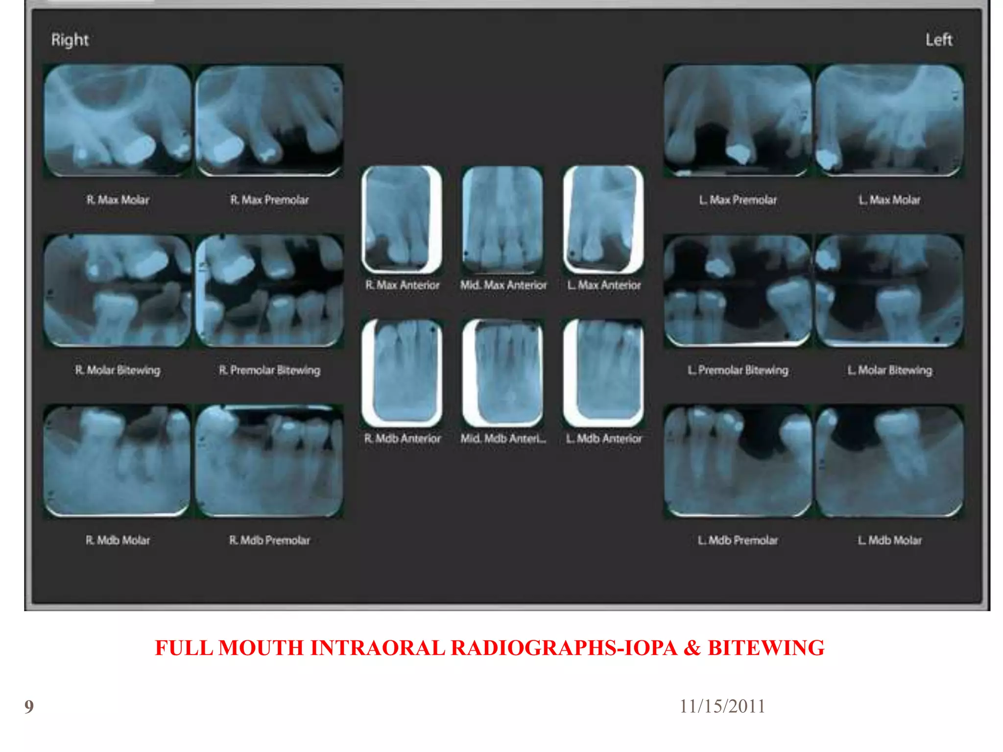 FULL MOUTH INTRAORAL RADIOGRAPHS-IOPA & BITEWING

9                                        11/15/2011
 