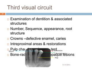 Third visual circuit
27


      Examination of dentition & associated
       structures
      Number, Sequence, appearance, root

       structure
      Crowns –defective enamel, caries

      Intreproximal areas & restorations

      Pulp chambers-size, contentRestoration
      Dentin
                                   Proximal caries
      Bone-radioluscent/radioopaque lesions
                                    Pulp


                                           11/15/2011
 