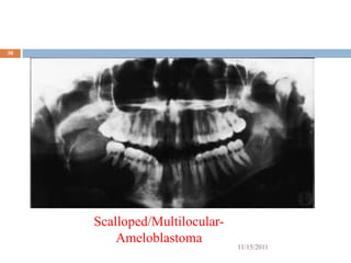 38




     Scalloped/Multilocular-
         Ameloblastoma
                               11/15/2011
 