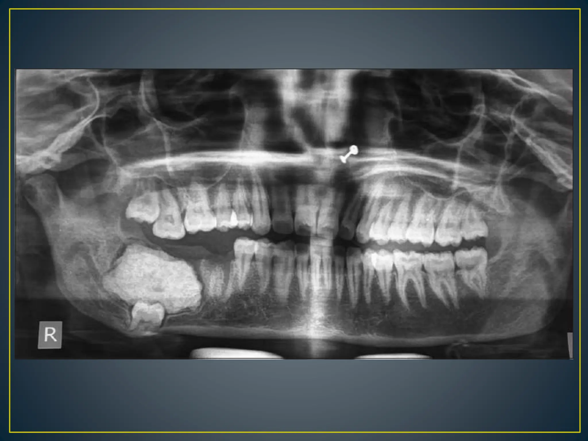 Radiographic Interpretation 1 Pptx