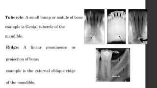 radiographic landmarks of maxilla and mandible | PPTX