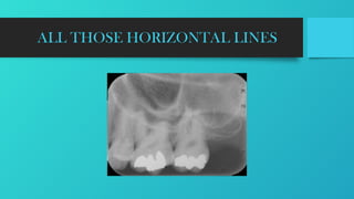 RADIOGRAPHIC LANDMARKS .pptx