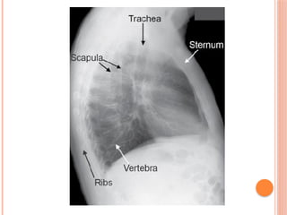 Radiographic Landmarks in Evaluating Chest Radiography.pptx