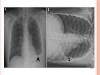 Radiographic Landmarks in Evaluating Chest Radiography.pptx