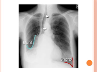 Radiographic Landmarks in Evaluating Chest Radiography.pptx