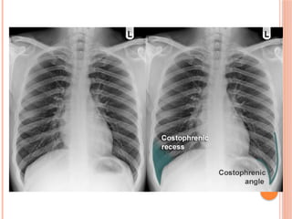 Radiographic Landmarks in Evaluating Chest Radiography.pptx