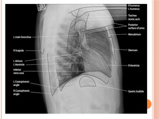 Radiographic Landmarks in Evaluating Chest Radiography.pptx