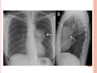 Radiographic Landmarks in Evaluating Chest Radiography.pptx