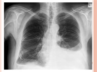 Radiographic Landmarks in Evaluating Chest Radiography.pptx