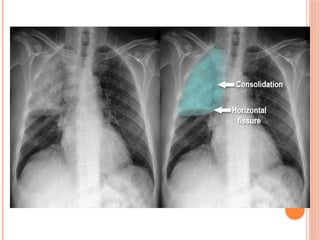 Radiographic Landmarks in Evaluating Chest Radiography.pptx