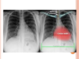 Radiographic Landmarks in Evaluating Chest Radiography.pptx