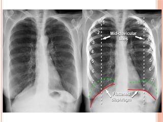 Radiographic Landmarks in Evaluating Chest Radiography.pptx