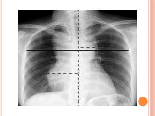 Radiographic Landmarks in Evaluating Chest Radiography.pptx