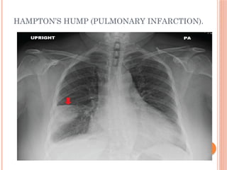 Radiographic Landmarks in Evaluating Chest Radiography.pptx