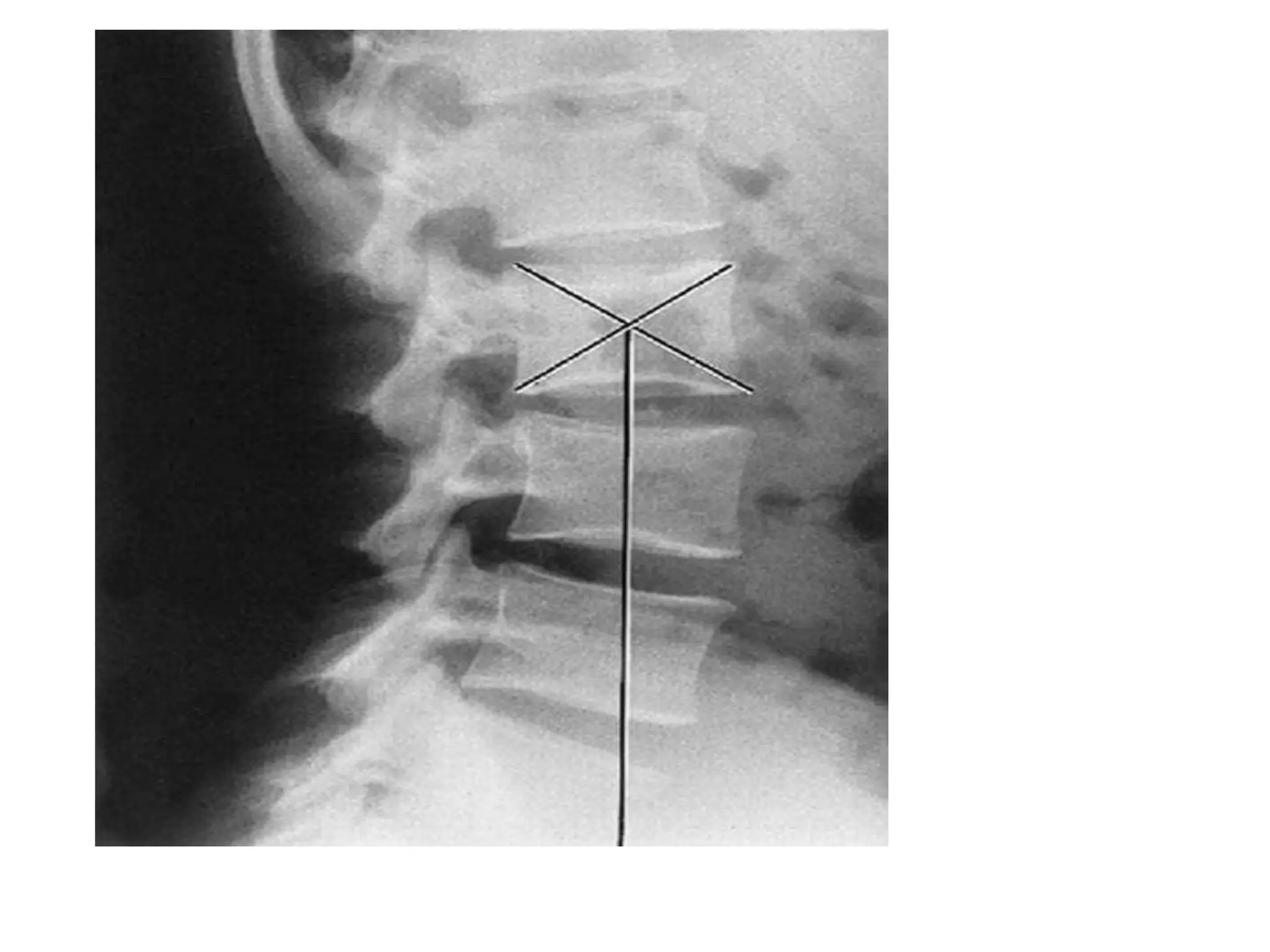 Radiographic lines and angles | PPTX