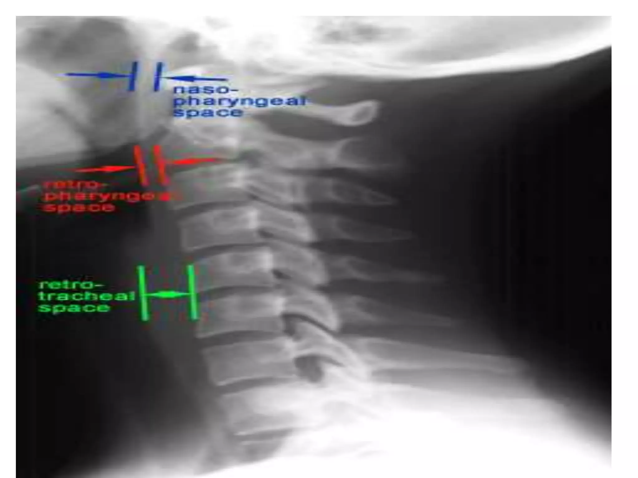 Radiographic lines and angles | PPTX