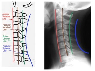 Side Rails Radiology Radiographic lines and angles | PPTX