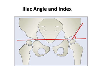 Iliac Angle and Index
 