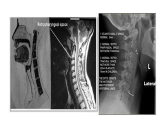 Radiographic lines and angles | PPTX