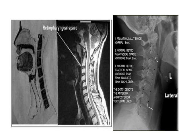 Radiographic lines and angles | PPTX