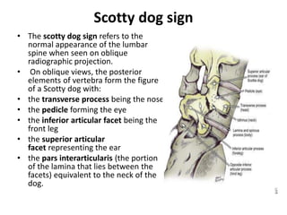 Scotty dog sign
• The scotty dog sign refers to the
normal appearance of the lumbar
spine when seen on oblique
radiographic projection.
• On oblique views, the posterior
elements of vertebra form the figure
of a Scotty dog with:
• the transverse process being the nose
• the pedicle forming the eye
• the inferior articular facet being the
front leg
• the superior articular
facet representing the ear
• the pars interarticularis (the portion
of the lamina that lies between the
facets) equivalent to the neck of the
dog.
 