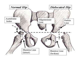 Radiographic lines and angles | PPTX