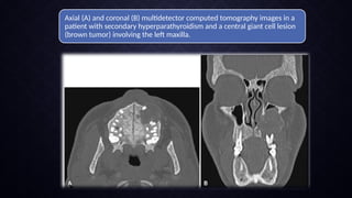 RADIOGRAPHIC MANIFESTATIONS OF SYSTEMIC DISORDERS IN JAWS.pptx