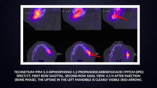 RADIOGRAPHIC MANIFESTATIONS OF SYSTEMIC DISORDERS IN JAWS.pptx