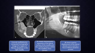 RADIOGRAPHIC MANIFESTATIONS OF SYSTEMIC DISORDERS IN JAWS.pptx