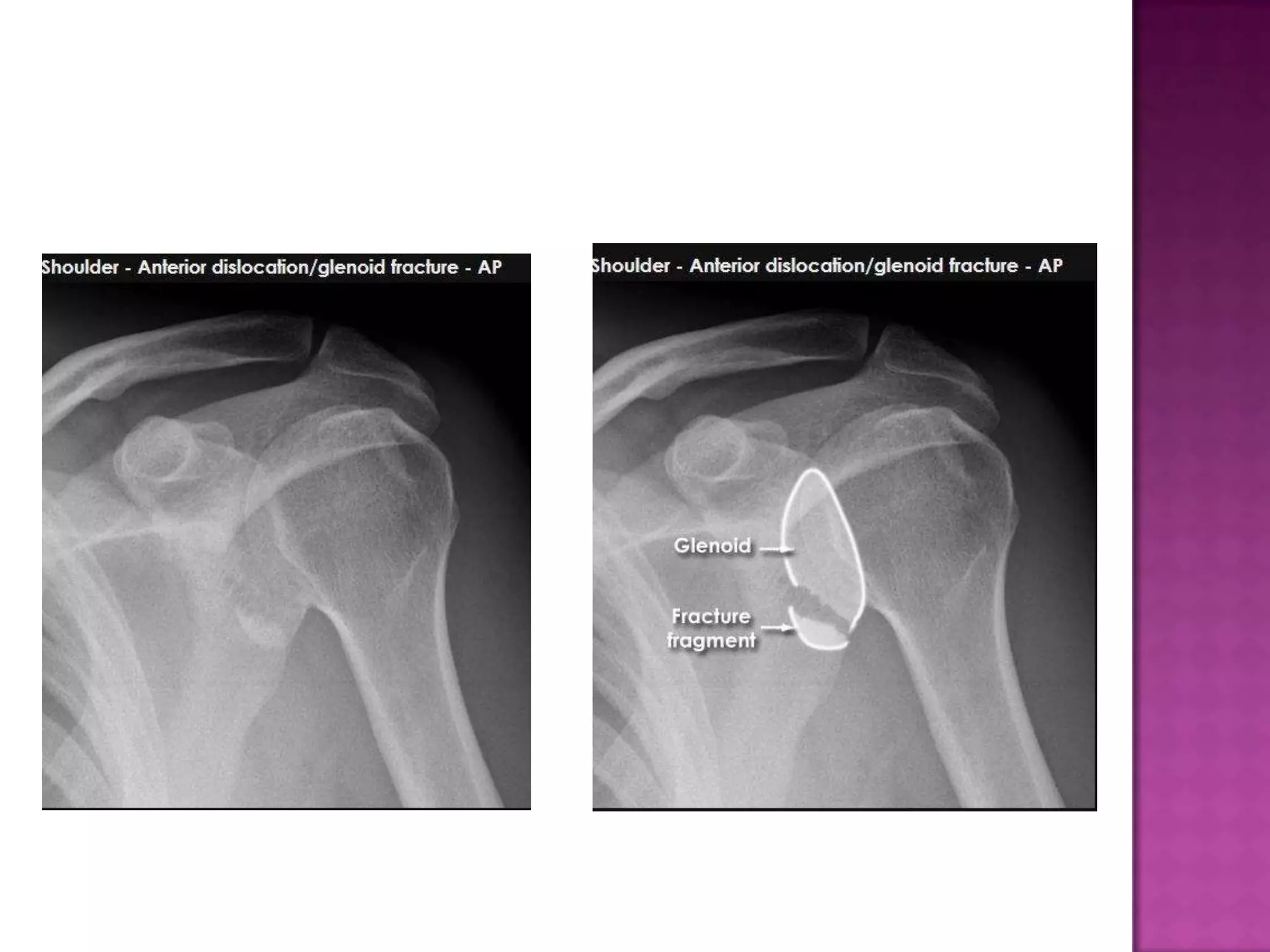 Radiographic positioning of humerus and shoulder | PPTX