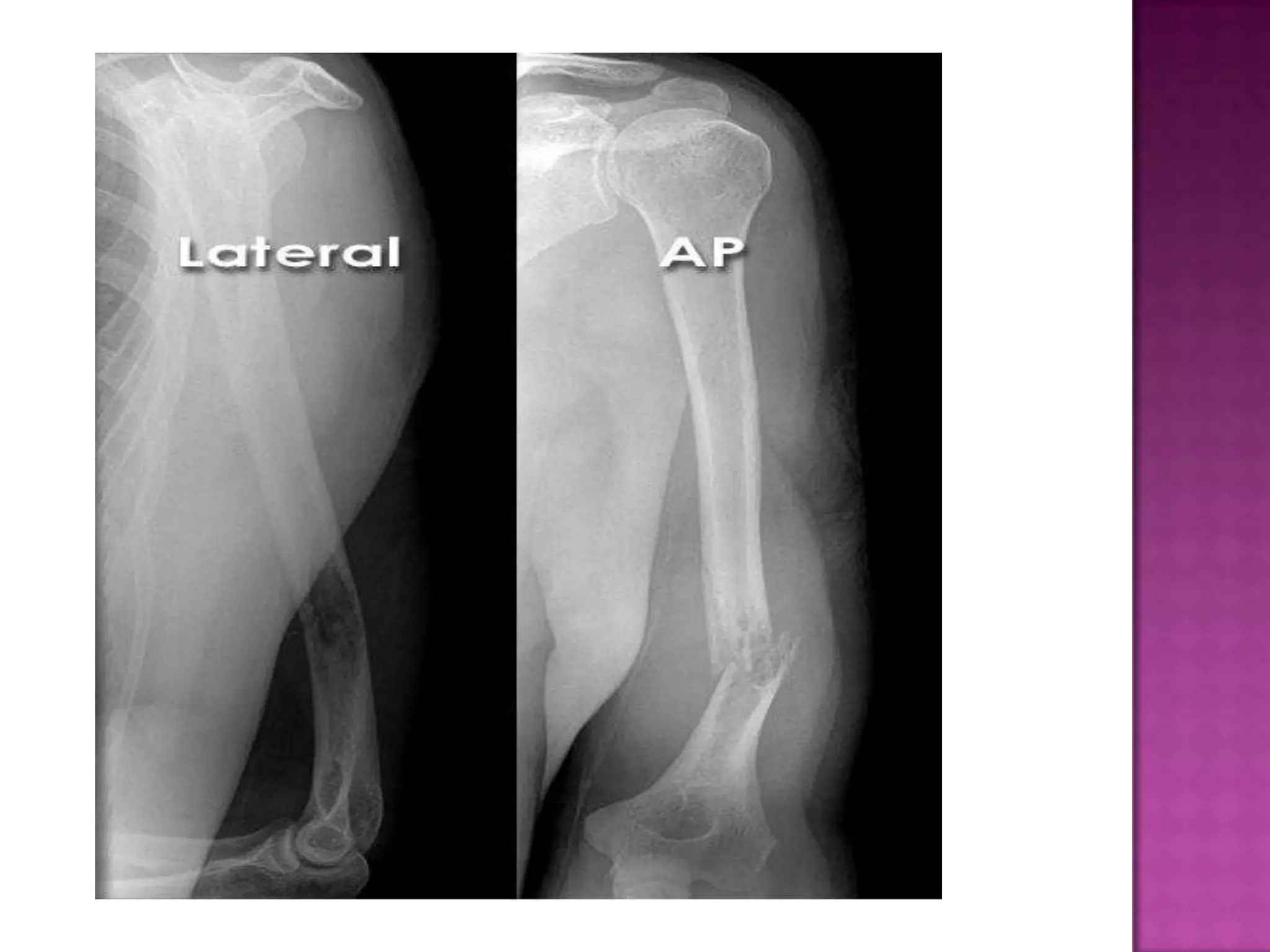 Radiographic positioning of humerus and shoulder | PPTX