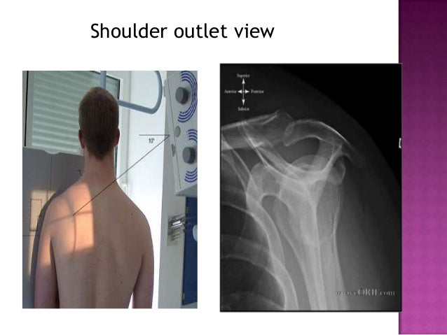 Radiographic positioning of humerus and shoulder