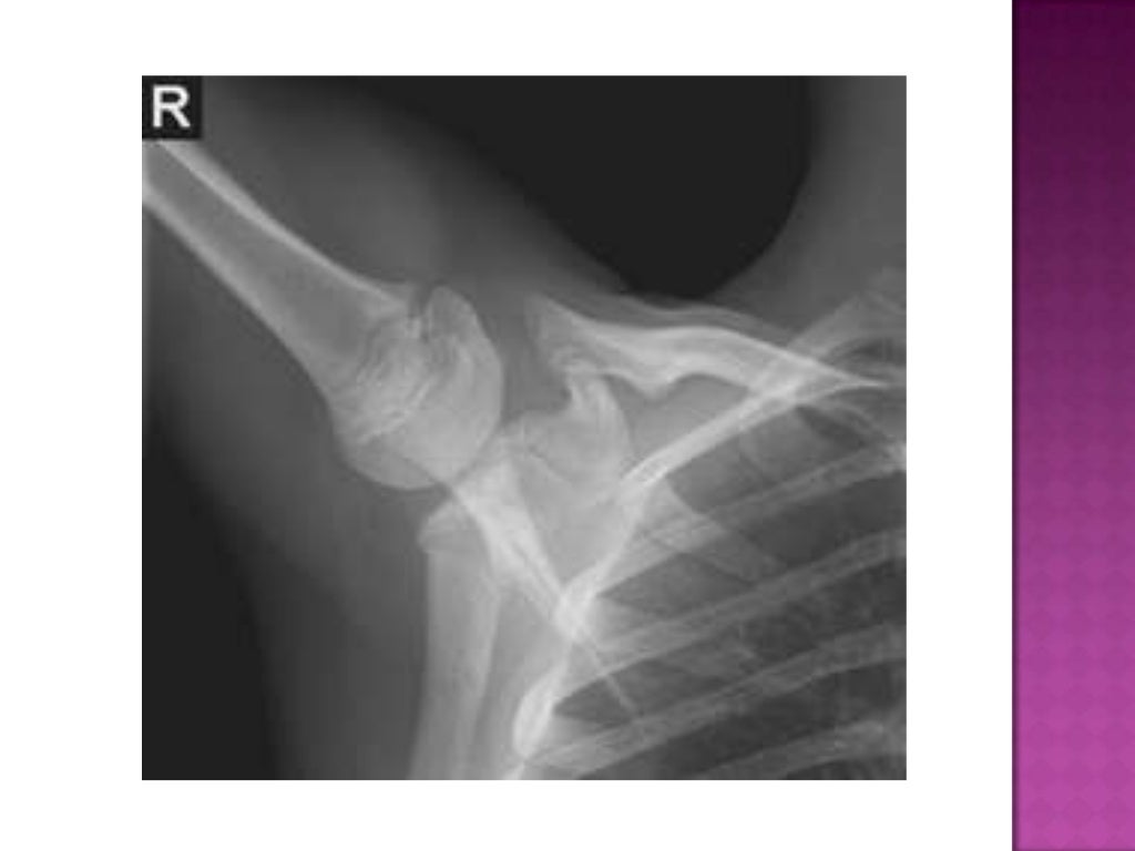 Radiographic positioning of humerus and shoulder