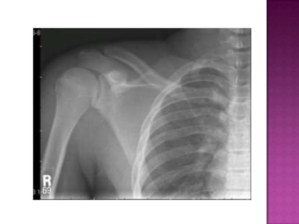 Radiographic positioning of humerus and shoulder