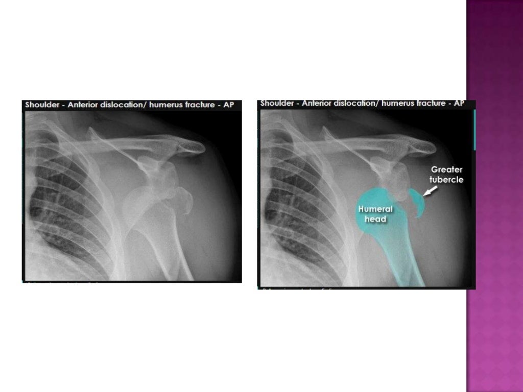 Radiographic positioning of humerus and shoulder