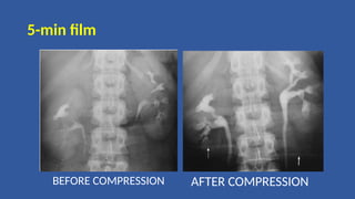 5-min film
BEFORE COMPRESSION AFTER COMPRESSION
 