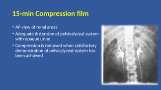 15-min Compression film
• AP view of renal areas
• Adequate distension of pelvicalyceal system
with opaque urine
• Compression is removed when satisfactory
demonstration of pelvicalyceal system has
been achieved
 