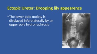 Ectopic Ureter: Drooping lily appearence
•The lower pole moiety is
displaced inferolaterally by an
upper pole hydronephrosis
 