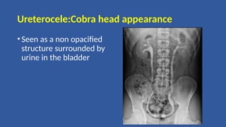 Ureterocele:Cobra head appearance
•Seen as a non opacified
structure surrounded by
urine in the bladder
 