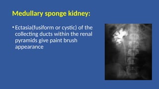 Medullary sponge kidney:
•Ectasia(fusiform or cystic) of the
collecting ducts within the renal
pyramids give paint brush
appearance
 