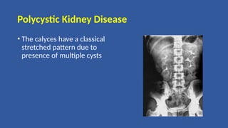 Polycystic Kidney Disease
• The calyces have a classical
stretched pattern due to
presence of multiple cysts
 