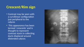 Crescent/Rim sign
• Contrast may be seen with
a curvilinear configuration
just peripheral to the
calyces
• This appearance has been
termed `crescents' and is
thought to represent
contrast stasis in collecting
ducts displaced around
distended calyces
 