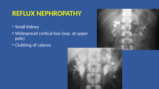 REFLUX NEPHROPATHY
• Small Kidney
• Widespread cortical loss (esp. at upper
pole)
• Clubbing of calyces
 