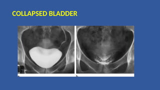 COLLAPSED BLADDER
 