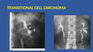 TRANSITIONAL CELL CARCINOMA
 
