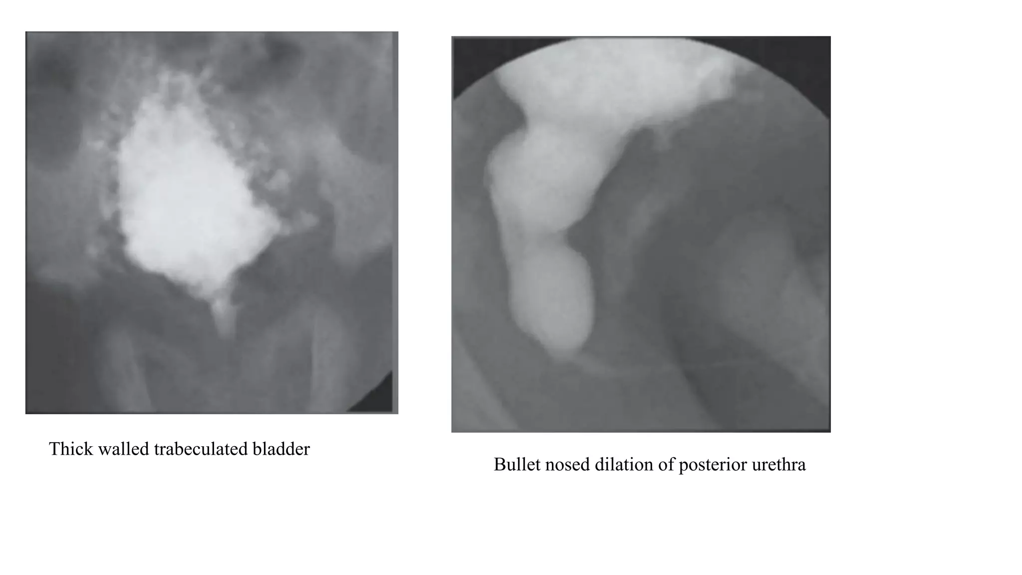 Thick walled trabeculated bladder
Bullet nosed dilation of posterior urethra
 