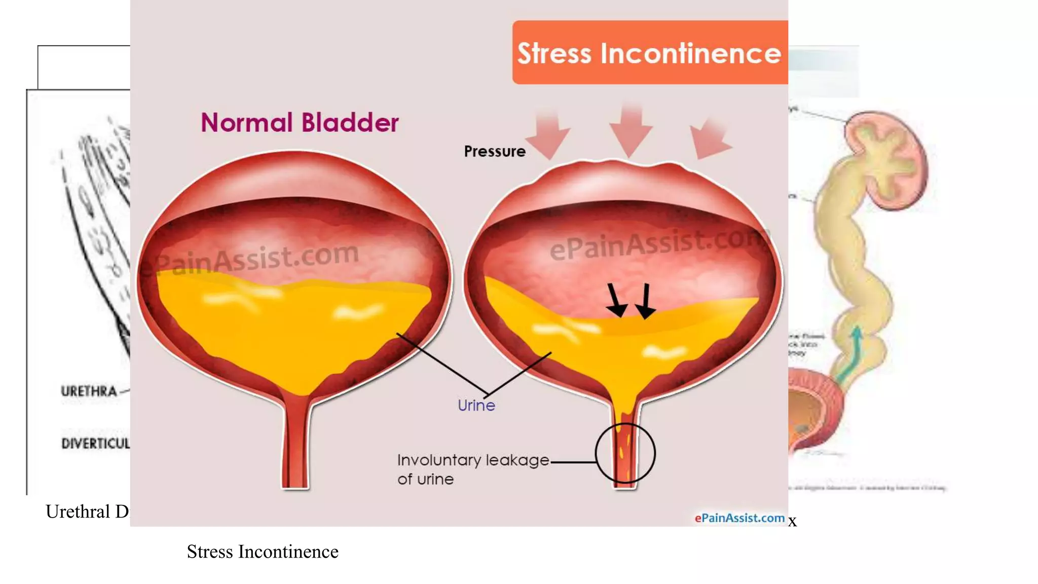 Indications
Urinary tract infection Dysuria
Urethral Diverticulum Vesico uretric reflux
Stress Incontinence
 